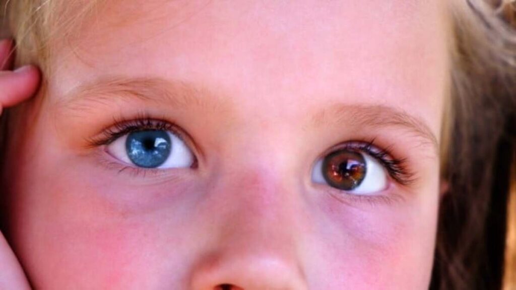 Heterochromy of the quadruplets