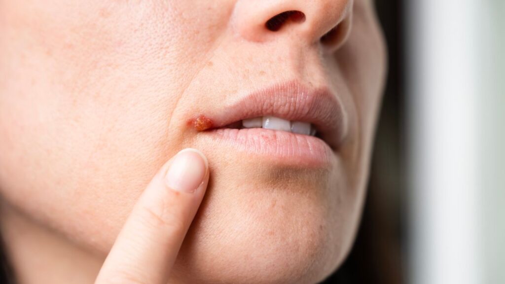 Cold sore mystery solved