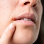Cold sore mystery solved
