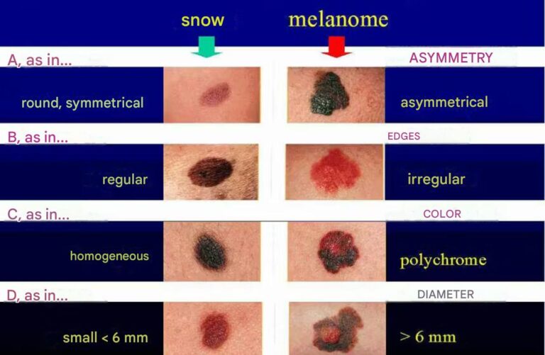 Why do we have moles? What these tiny skin marks really mean